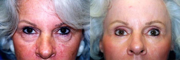Eyelid Surgery Before & After Gallery - Patient 414306 - Image 1
