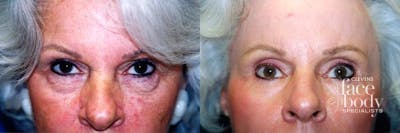 Eyelid Surgery Before & After Gallery - Patient 414306 - Image 1
