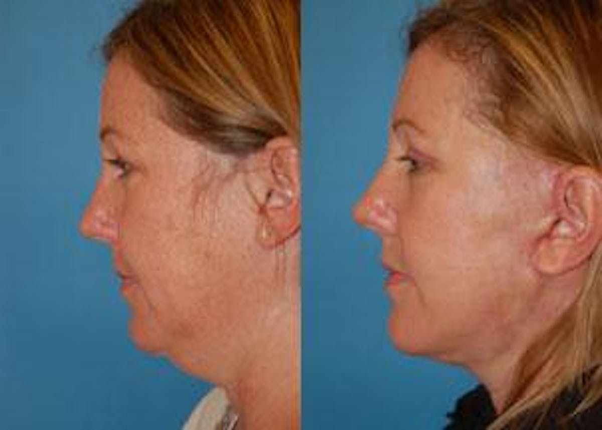 Facelift Before & After Gallery - Patient 122405863 - Image 1