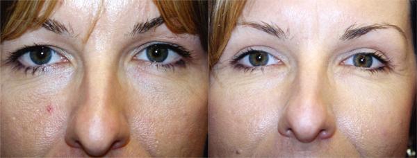 Eyelid Surgery Before & After Gallery - Patient 100740 - Image 1