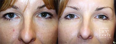 Eyelid Surgery Before & After Gallery - Patient 100740 - Image 1