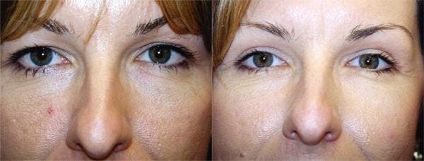 Eyelid Surgery Before & After Gallery - Patient 122405864 - Image 1