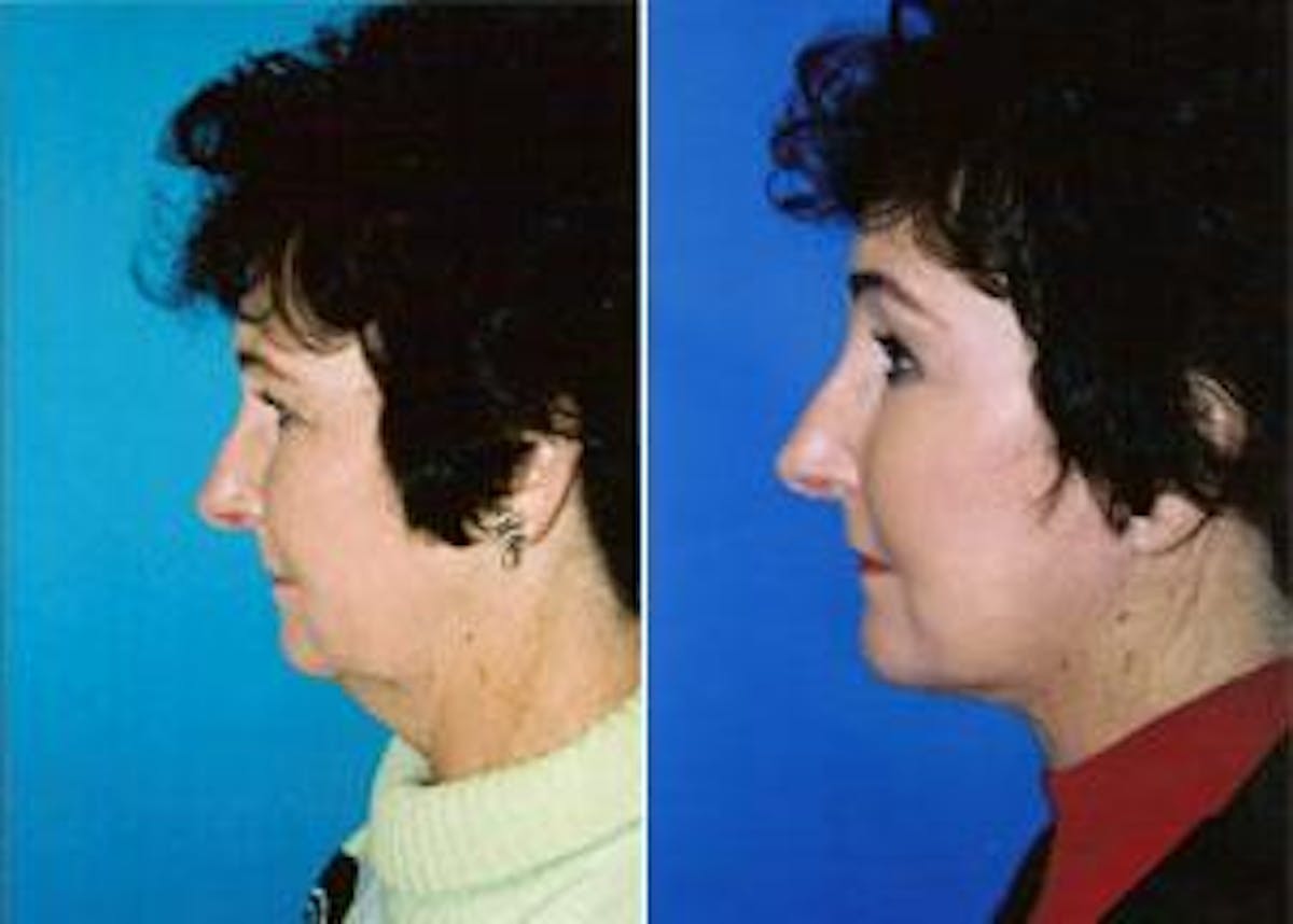 Facelift Before & After Gallery - Patient 122405865 - Image 1