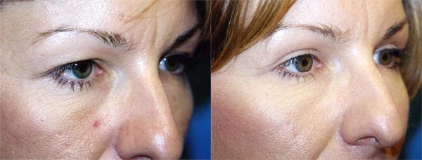 Eyelid Surgery Before & After Gallery - Patient 122405864 - Image 2