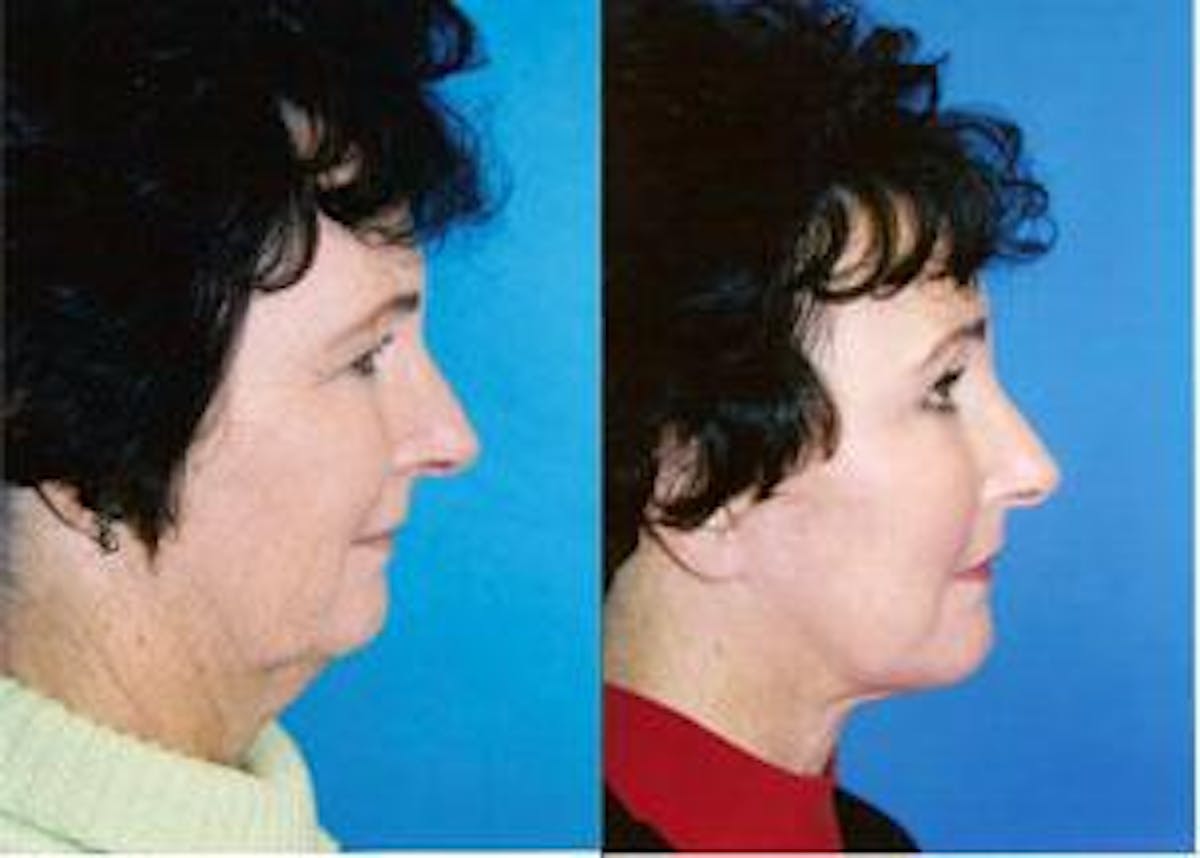 Facelift Before & After Gallery - Patient 122405865 - Image 2