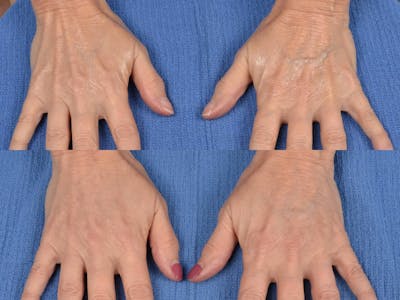 Hand Lift Before & After Gallery - Patient 122405866 - Image 1
