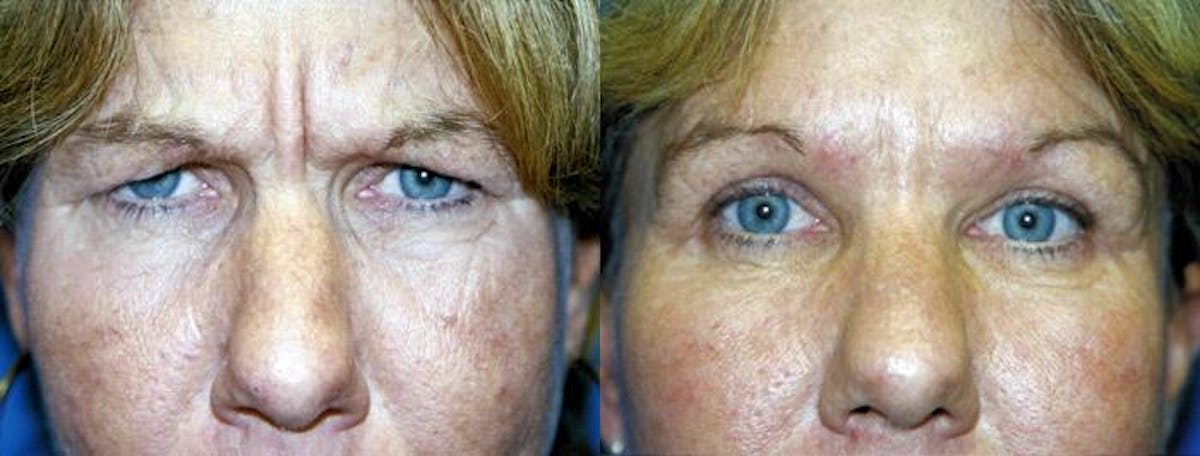 Eyelid Surgery Before & After Gallery - Patient 122405867 - Image 1