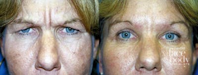 Eyelid Surgery Before & After Gallery - Patient 418240 - Image 1