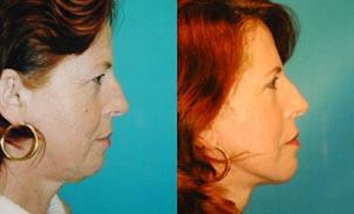 Facelift Before & After Gallery - Patient 122405869 - Image 1
