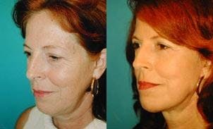Facelift Before & After Gallery - Patient 122405869 - Image 2