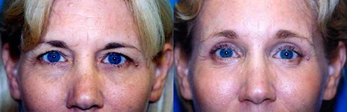 Eyelid Surgery Before & After Gallery - Patient 476333 - Image 1