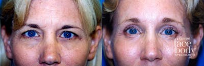 Eyelid Surgery Before & After Gallery - Patient 476333 - Image 1