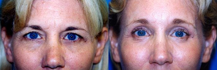 Eyelid Surgery Before & After Gallery - Patient 122405870 - Image 1