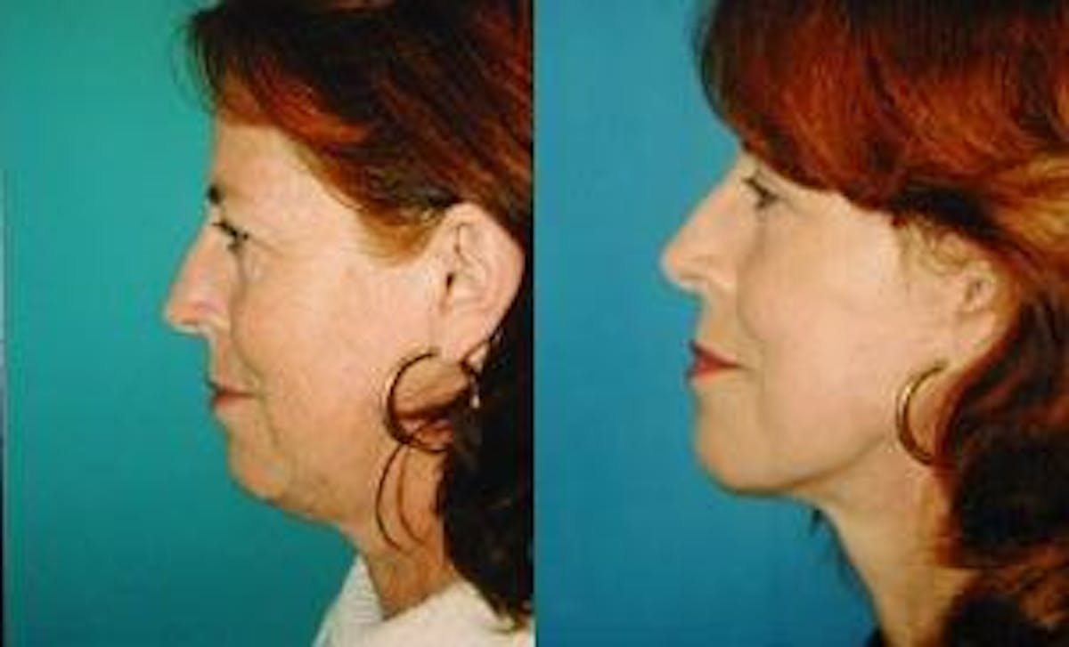 Facelift Before & After Gallery - Patient 122405869 - Image 3