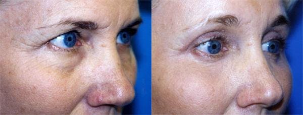 Eyelid Surgery Before & After Gallery - Patient 122405870 - Image 2