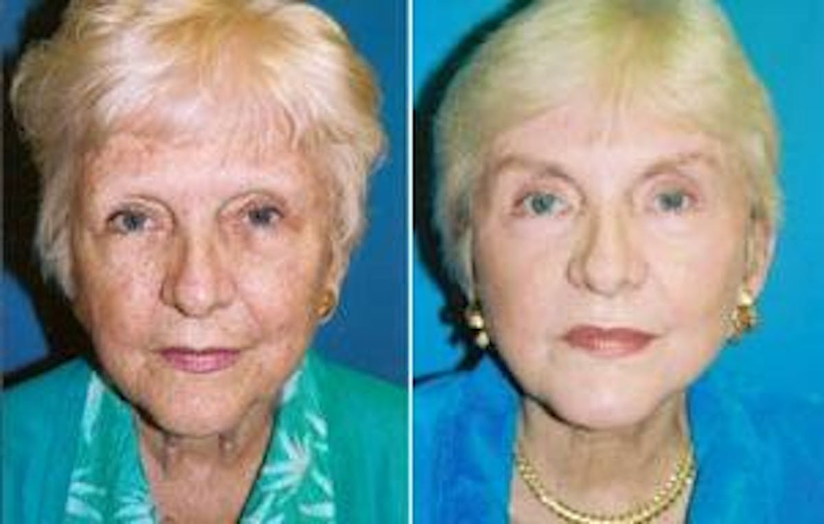Facelift Before & After Gallery - Patient 122405872 - Image 1