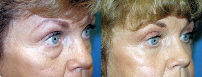 Eyelid Surgery Before & After Gallery - Patient 166879 - Image 1