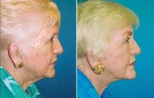 Facelift Before & After Gallery - Patient 122405872 - Image 2