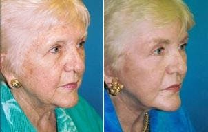 Facelift Before & After Gallery - Patient 122405872 - Image 3