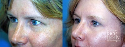 Eyelid Surgery Before & After Gallery - Patient 473365 - Image 1