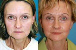 Facelift Before & After Gallery - Patient 122405875 - Image 1