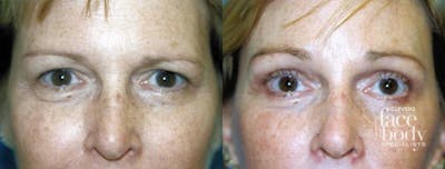 Eyelid Surgery Before & After Gallery - Patient 666758 - Image 1