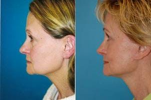 Facelift Before & After Gallery - Patient 122405875 - Image 2