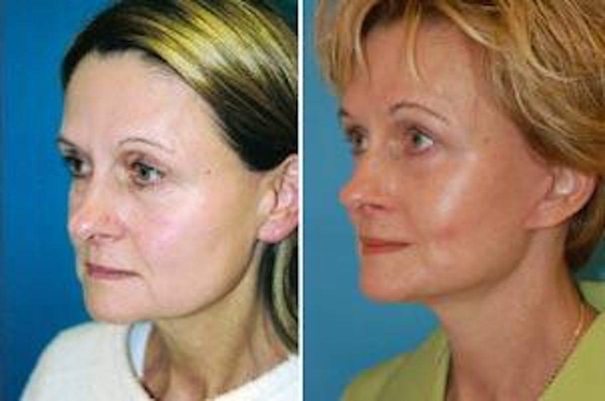 Facelift Before & After Gallery - Patient 122405875 - Image 3