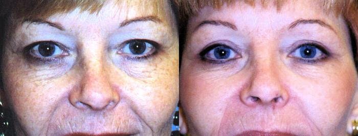 Eyelid Surgery Before & After Gallery - Patient 122405876 - Image 1