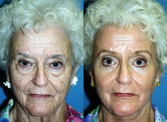 Facelift Before & After Gallery - Patient 122405878 - Image 1
