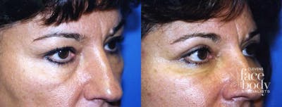 Eyelid Surgery Before & After Gallery - Patient 368529 - Image 1
