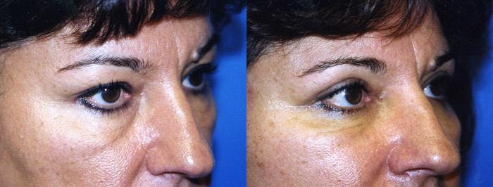 Eyelid Surgery Before & After Gallery - Patient 122405877 - Image 1