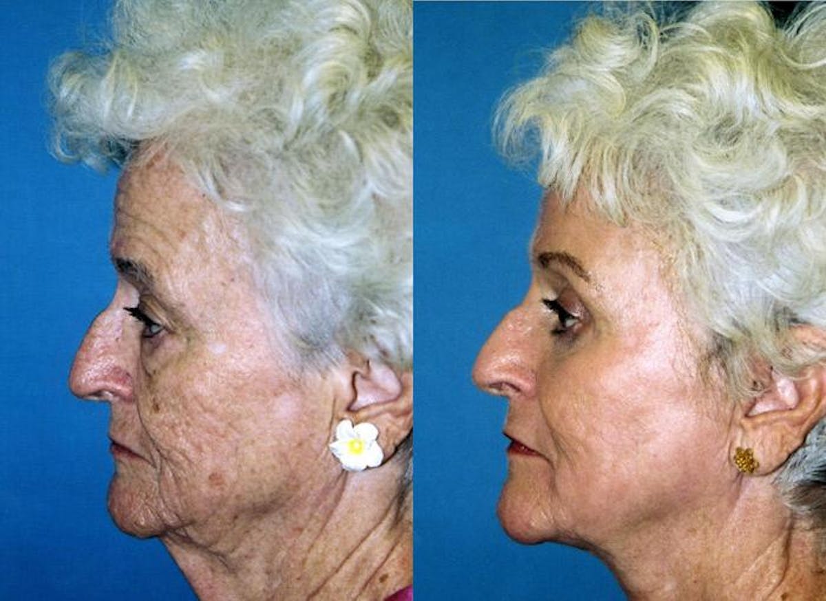 Facelift Before & After Gallery - Patient 122405878 - Image 2