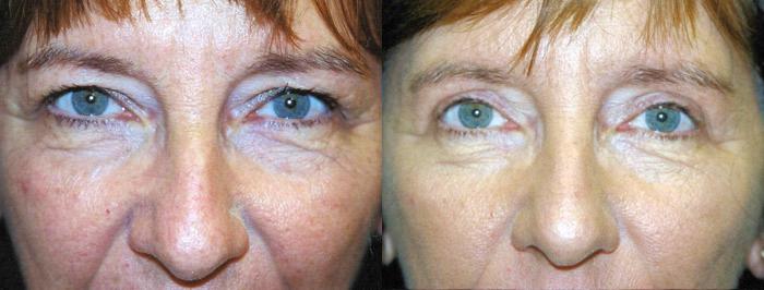 Eyelid Surgery Before & After Gallery - Patient 678086 - Image 1
