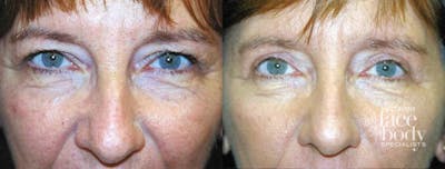 Eyelid Surgery Before & After Gallery - Patient 678086 - Image 1
