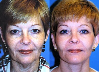 Facelift Before & After Gallery - Patient 122405881 - Image 1