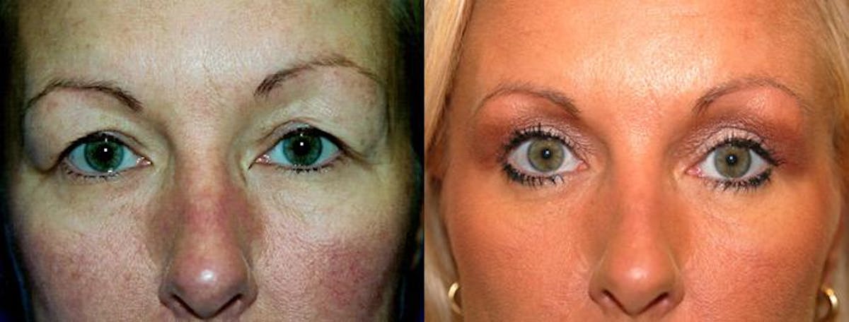 Eyelid Surgery Before & After Gallery - Patient 122405880 - Image 1