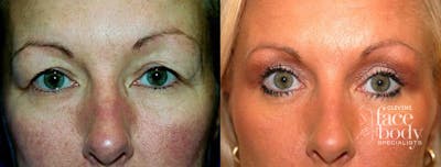 Eyelid Surgery Before & After Gallery - Patient 362159 - Image 1