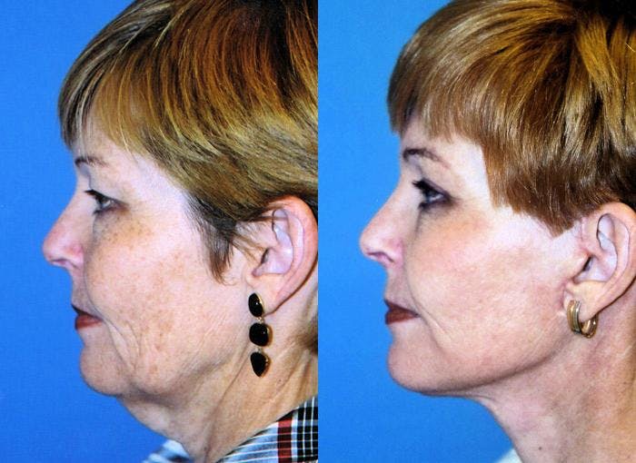 Facelift Before & After Gallery - Patient 122405881 - Image 2