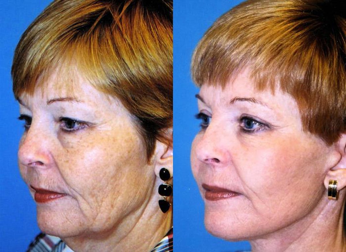 Facelift Before & After Gallery - Patient 122405881 - Image 3