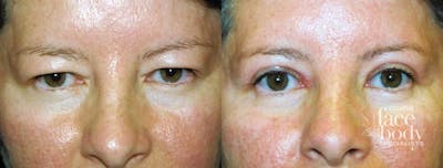 Eyelid Surgery Before & After Gallery - Patient 378986 - Image 1