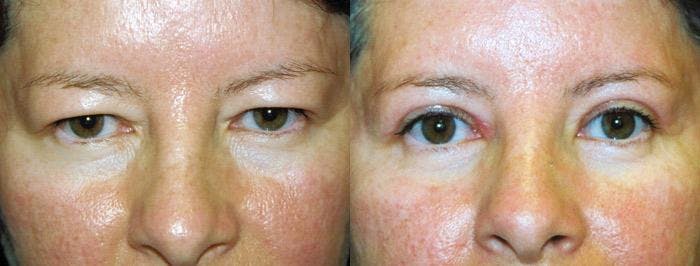 Eyelid Surgery Gallery - Patient 122405882 - Image 1