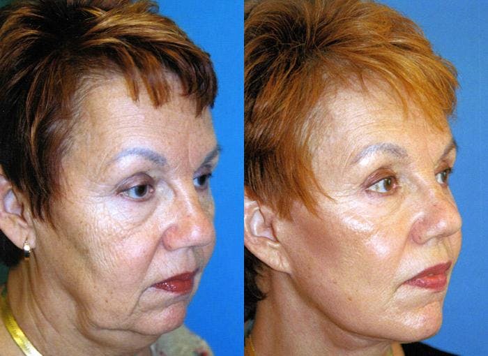Facelift Before & After Gallery - Patient 122405883 - Image 1