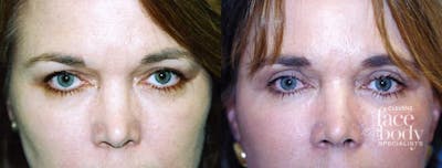Eyelid Surgery Before & After Gallery - Patient 258467 - Image 1