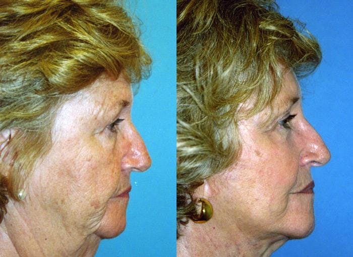 Facelift Before & After Gallery - Patient 122405884 - Image 1