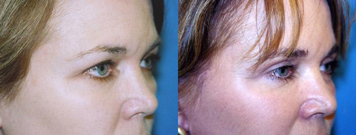 Eyelid Surgery Before & After Gallery - Patient 258467 - Image 2