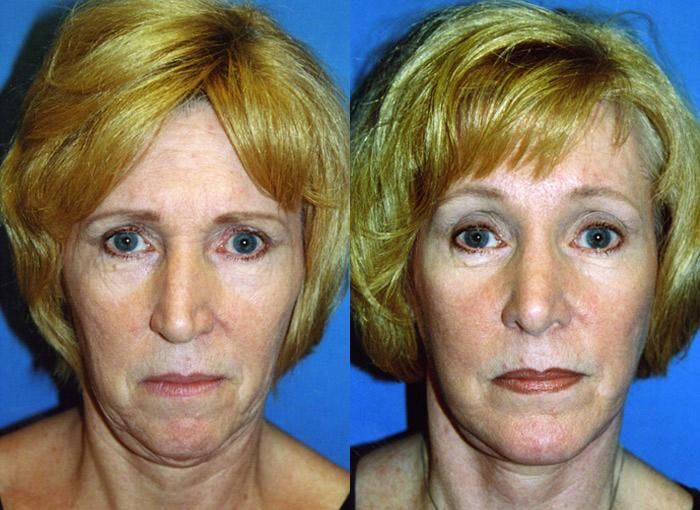 Facelift Before & After Gallery - Patient 122405887 - Image 1