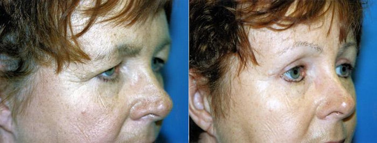 Eyelid Surgery Before & After Gallery - Patient 122405886 - Image 1