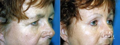Eyelid Surgery Before & After Gallery - Patient 241460 - Image 1