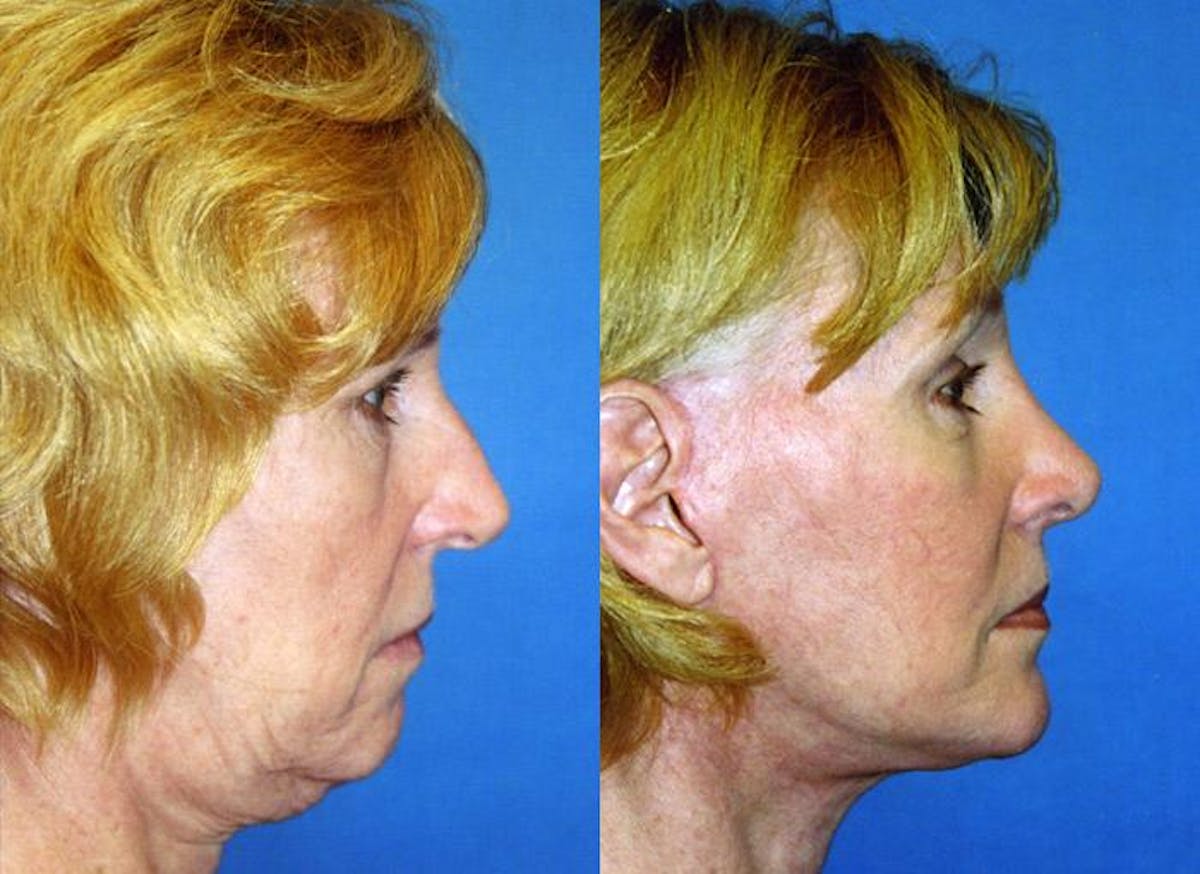 Facelift Before & After Gallery - Patient 122405887 - Image 2